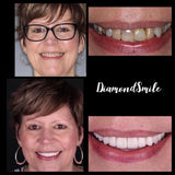 ONTDEK: Diamond Smile - Professioneel tanden bleken